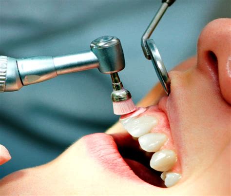 profilaxis dental
